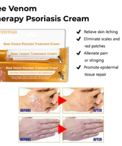 Alternative view of Oveallgo™ ULTRA Bee Venom Therapeutic Psoriasis Cream