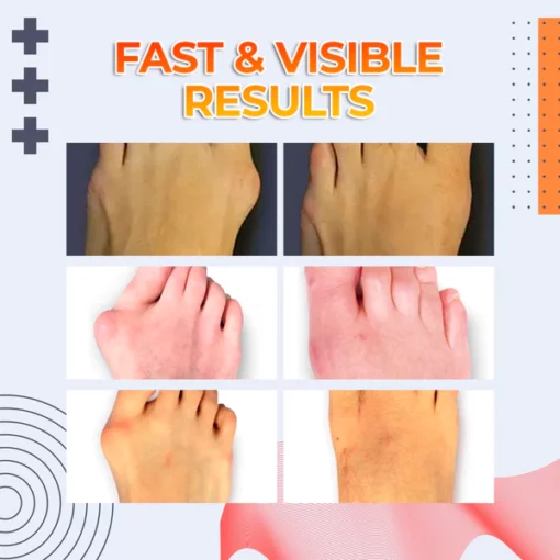 Drto Bunion Splint Correclor