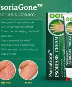 PsoriaGone™ Natural Herbaceous Plants Psoriasis Cream