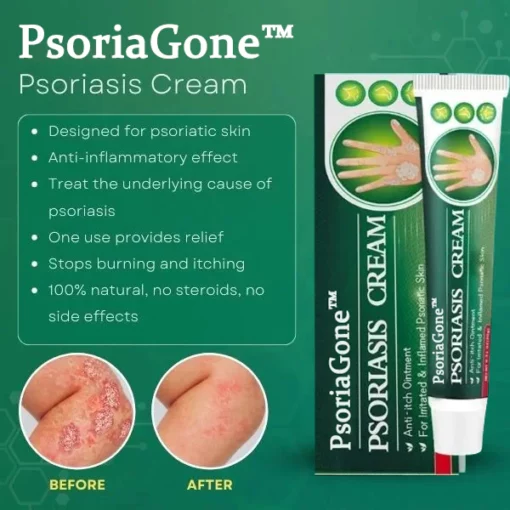 PsoriaGone™ Natural Herbaceous Plants Psoriasis Cream