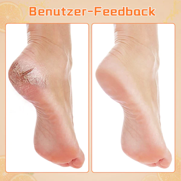 Biancat Hornhaut-Entfernendes FuAspray