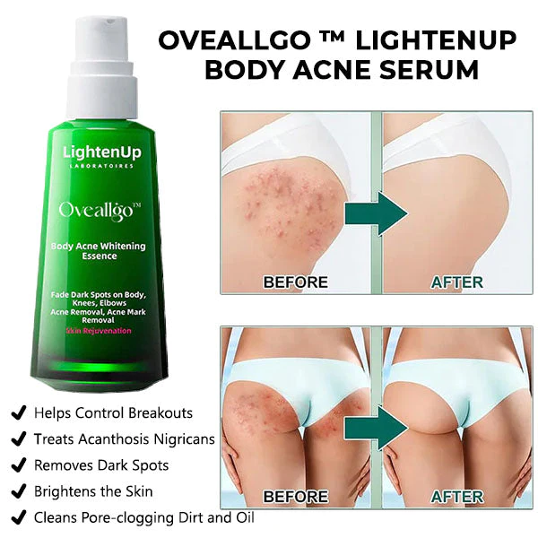 Oveallgo Krper Aufhellen Akne-Serum (zur Entfernung von Akne, Pickeln und Acanthosis nigricans)