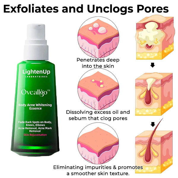 Oveallgo Krper Aufhellen Akne-Serum (zur Entfernung von Akne, Pickeln und Acanthosis nigricans)