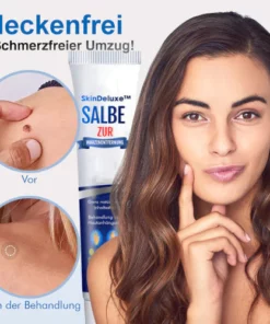 Alternative view of SkinDeluxe™ Salbe zur Warzenentfernung
