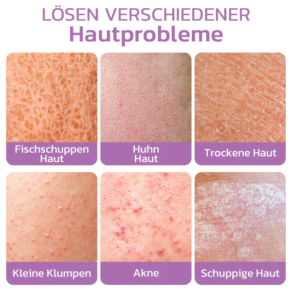 flysmus KP Keratose Gleichgewicht Radiergummi Krper Peeling