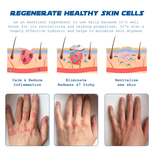 ATTDX Psoriasis Treatment BeeVenom Cream - Image 3
