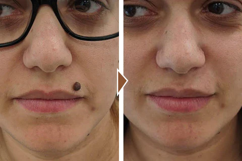 Biancat™ ClearDot Mole Removal Serum - Ofbylding 6