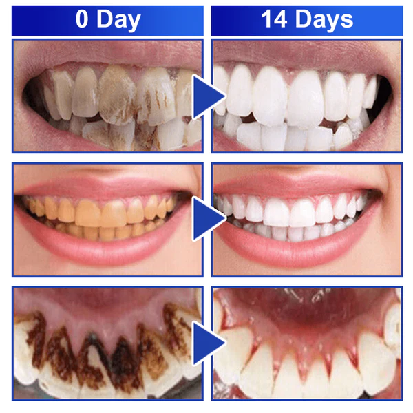 GFOUK PureSmile Essence