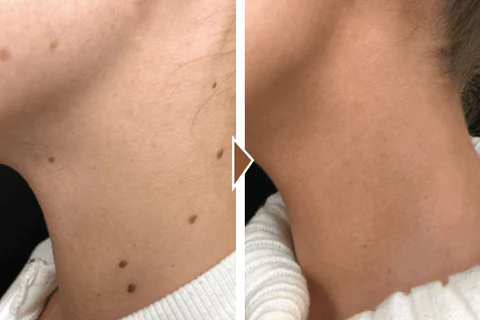 Biancat™ ClearDot Mole Removal Serum - Ofbylding 5