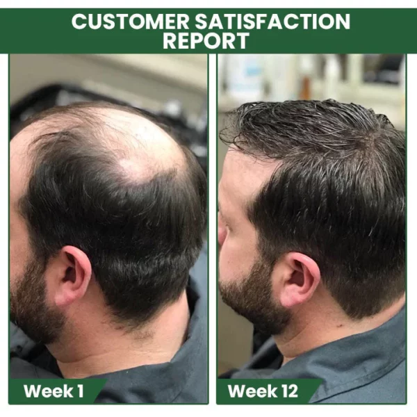 Oveallgo PROMAX ScalpRevive Minoxidil Growth Roller