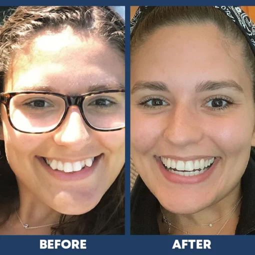 LIMETOW Dental Orthodontic Braces