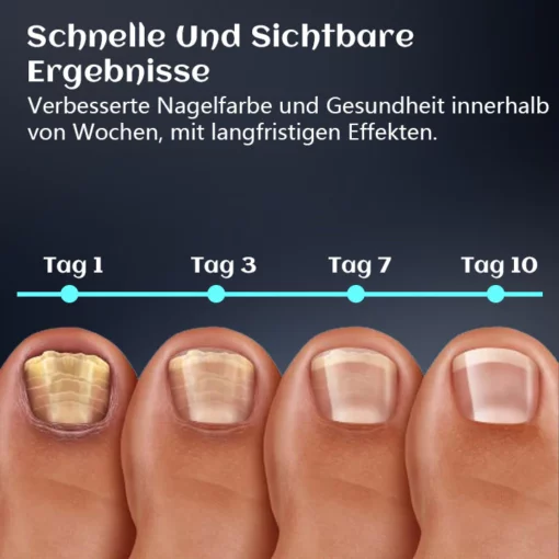 Biancat PediBeam Zehennagel Lichttherapieger