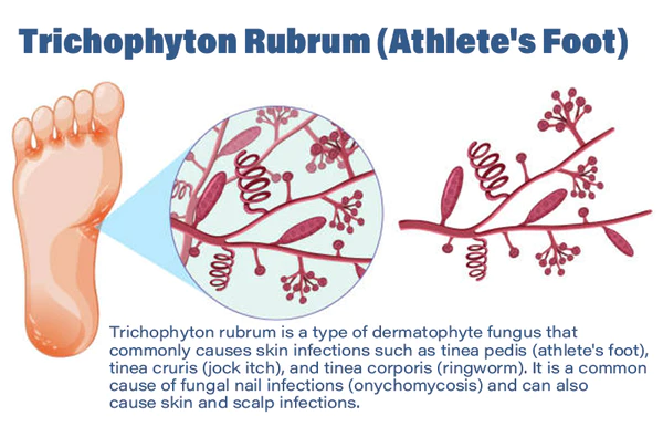 Furzero Medizinisches Nagelpilz-FuAspray