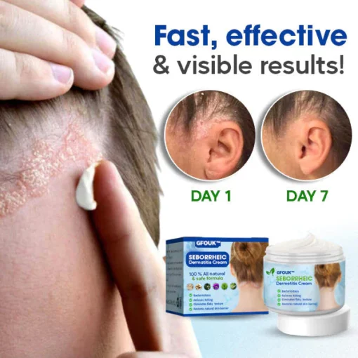 GFOUK Seborrheic Dermatitis Cream