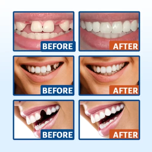 Unpree Temporary Moldable False Tooth