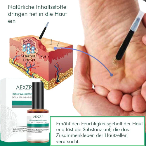 AEXZR Hhneraugenentfernung Extra Starkes Gel