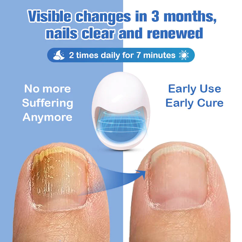 Furzero Nail Fungus Cleaning Laser Relief Device