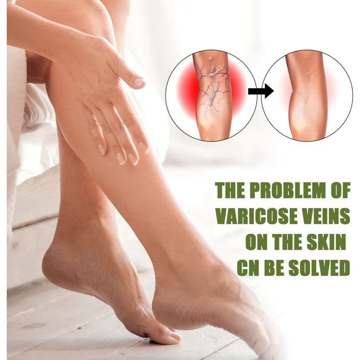 Lovild Varicose Veins Spray
