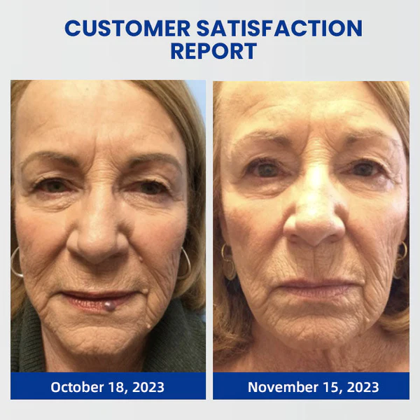 Lovilds Instant Blemish Removal Cream