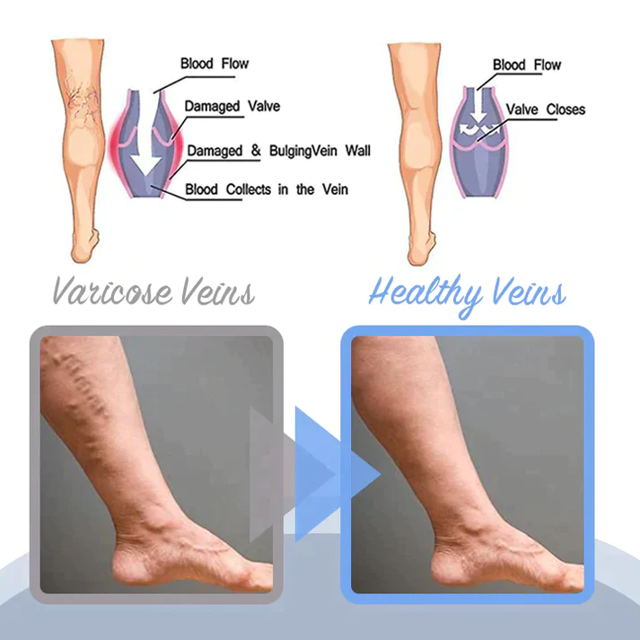 Lovild Varicose Veins Spray