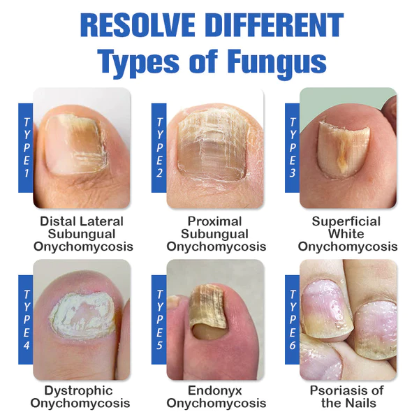 Furzero™ le dispositif laser pour soulager les mycose des ongles - Image 9