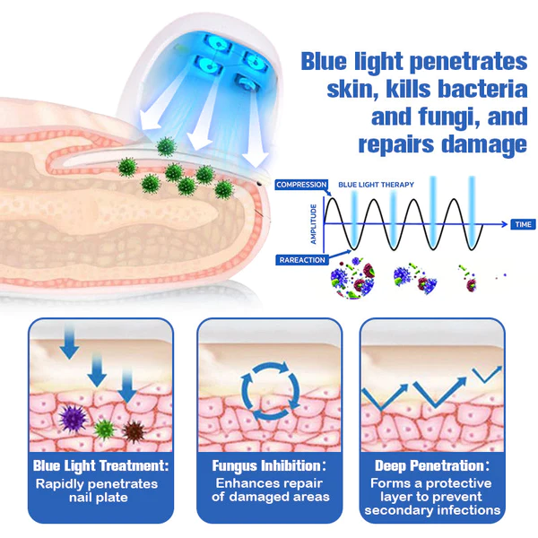 Furzero™ le dispositif laser pour soulager les mycose des ongles - Image 8