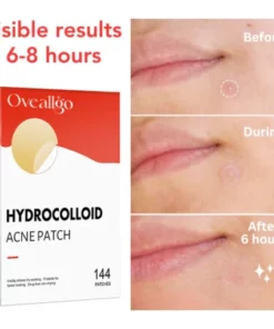 Alternative view of Oveallgo™ Nighttime Acne Patch