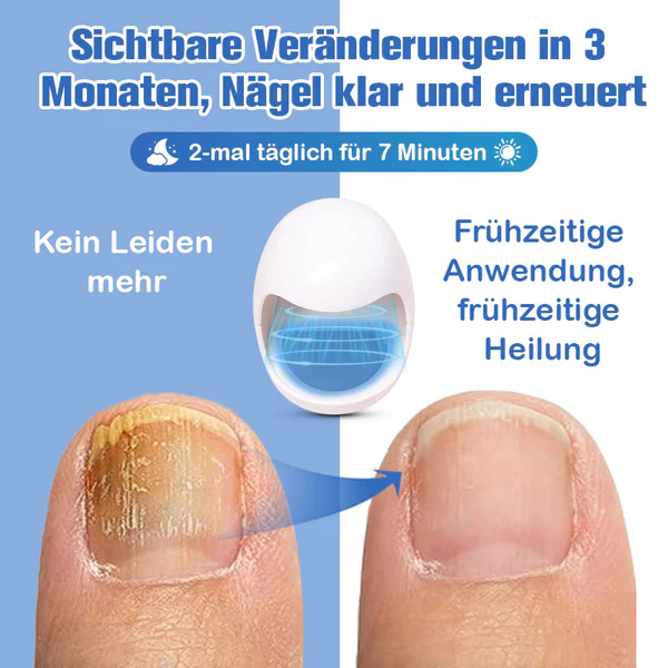 Furzero Nagelpilzreinigung Laser Linderungsger