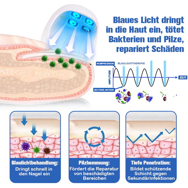 Furzero Nagelpilzreinigung Laser Linderungsger