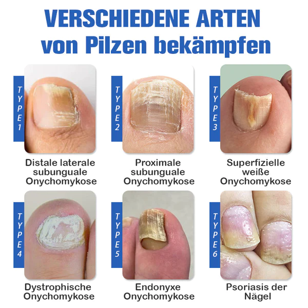 Furzero Nagelpilzreinigung Laser Linderungsger