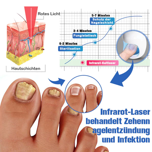 Furzero Nagelpilzreinigung Laser Linderungsger