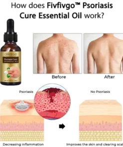 Alternative view of Fivfivgo™ Psoriasis Cure Essential Oil