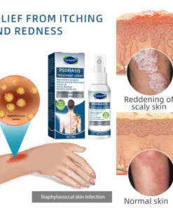 Alternative view of Ourlyard™ Psoriasis and Eczema Natural Herbal Treatment Spray