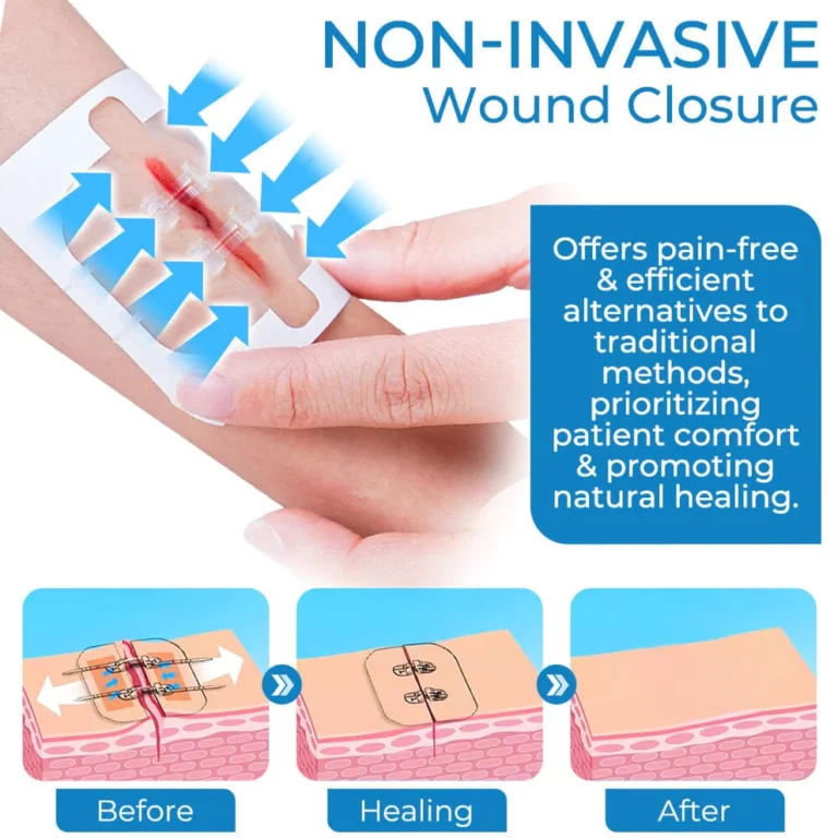 GFOUK StitchClosure Device