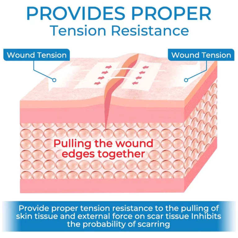 GFOUK StitchClosure Device
