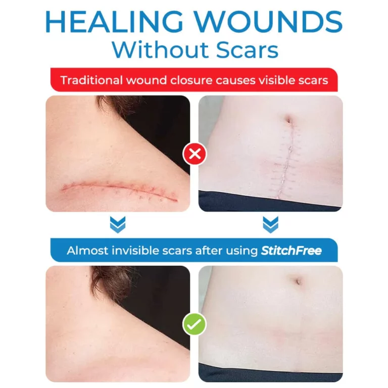 GFOUK StitchClosure Device