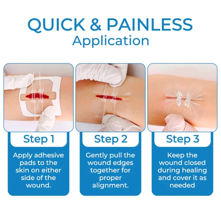 GFOUK StitchClosure Device