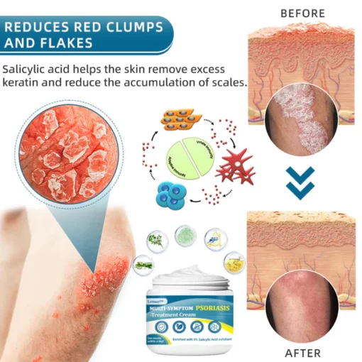 Lotmay™ Multi-Symptom Psoriasis Treatment Cream - Image 7