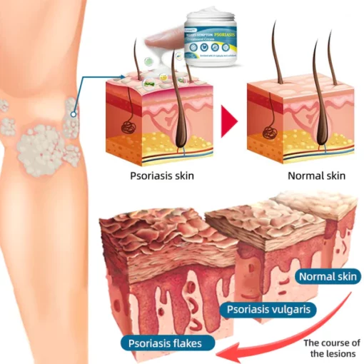 Lotmay™ Multi-Symptom Psoriasis Treatment Cream - Image 10