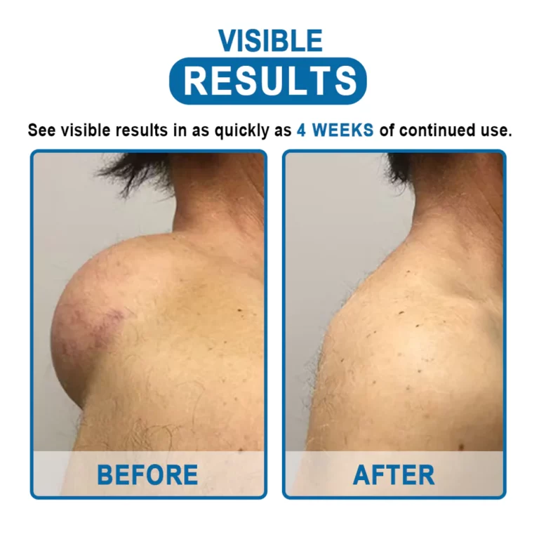 Uachtar toirt air falbh KISSHI ™ Lipoma - Ìomhaigh 11