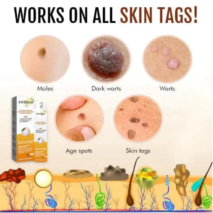 Fivfivgo™ Warze und Tags Entfernungsbehandlungsspray - Image 7