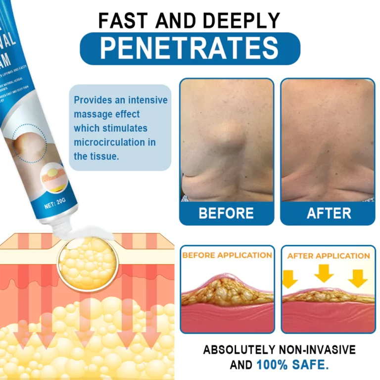 Uachtar toirt air falbh KISSHI ™ Lipoma - Ìomhaigh 5