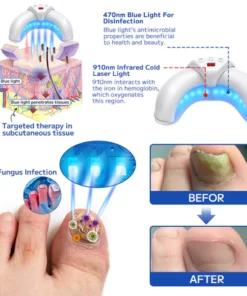 Alternative view of Furzero™ Fungal Nail Treatment Laser Device