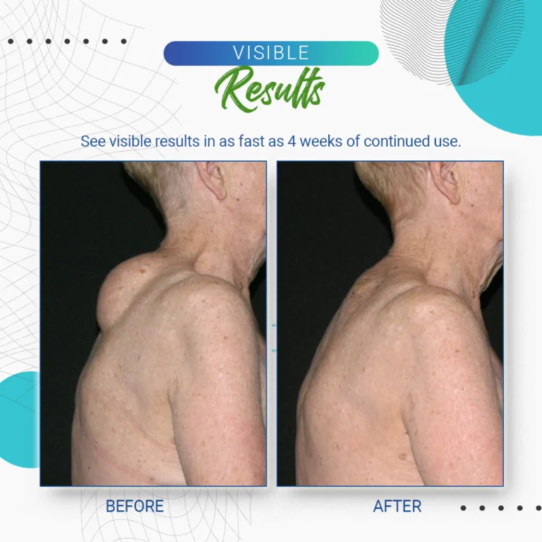 Uachtar toirt air falbh KISSHI ™ Lipoma - Ìomhaigh 10