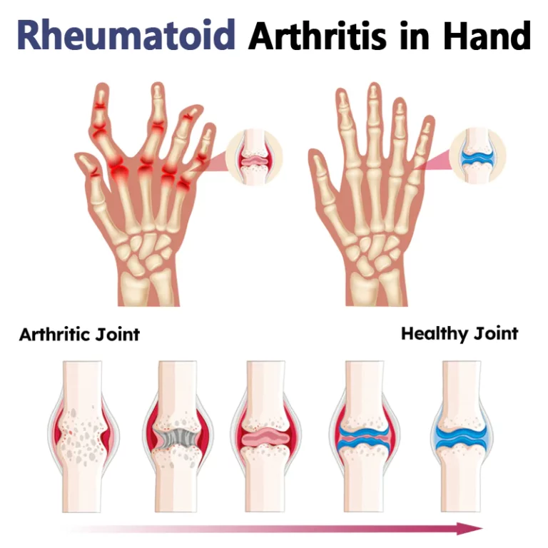 BeeZen New Zealand Bee Venom Joint and Bone Therapy Advanced Cream