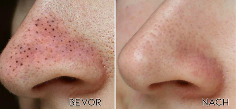 Fivfivgo™ Ultraschall-Porenabsauger BlackheadRemover PoreVacuum - kuva 5