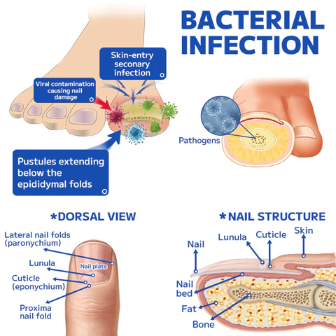 Furzero Fungal Nail Treatment Laser Device