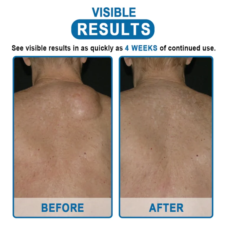 Uachtar toirt air falbh KISSHI ™ Lipoma - Ìomhaigh 8