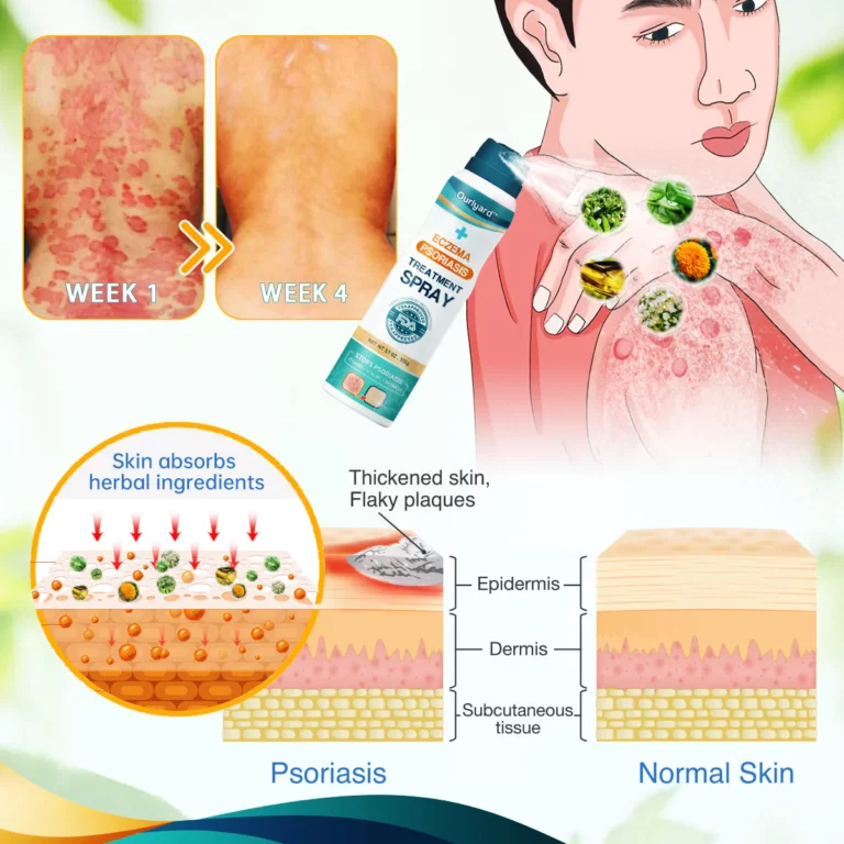 Ourlyard Psoriasis- und Ekzem-Naturheilmittel-Spray