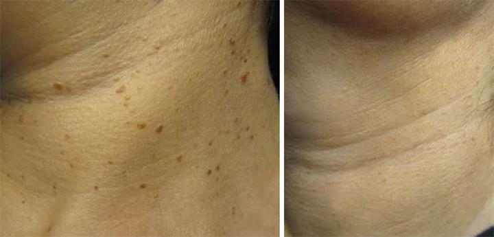 Ceoerty™ Bee Venom ClearSkin Wart and Tags Removal Treatment Spray - Image 8